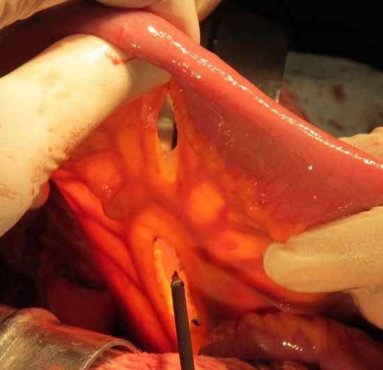 Мобилизация сегмента подвздошной кишки для формирования артифициального мочевого пузыря