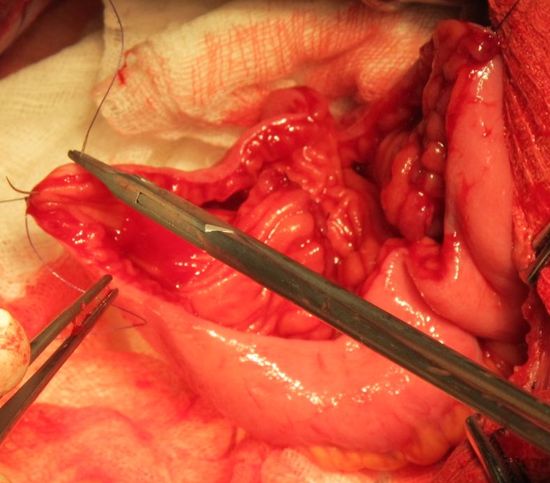 Формирование артифициального мочевого пузыря