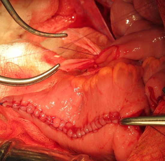ФОрмирования анастомозов между мочеточниками и недетубулиризированным участком необладера