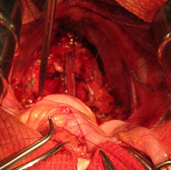 Наложены провизорные швы на уретру