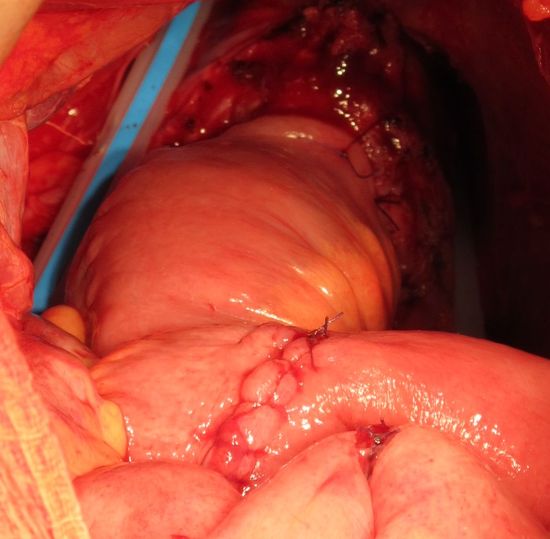 Необладер фиксирован в ортотопической позиции. Малый таз дренирован двумя дренажными трубками.