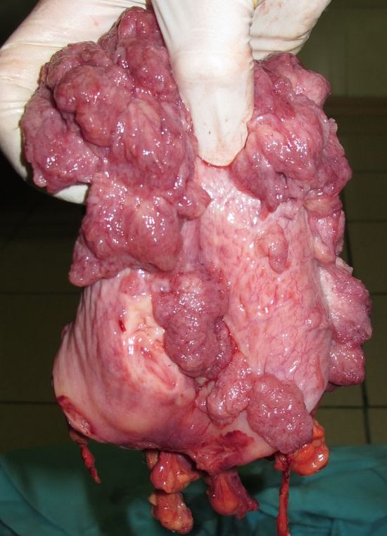 Удаленный мочевой пузырь с опухолью.