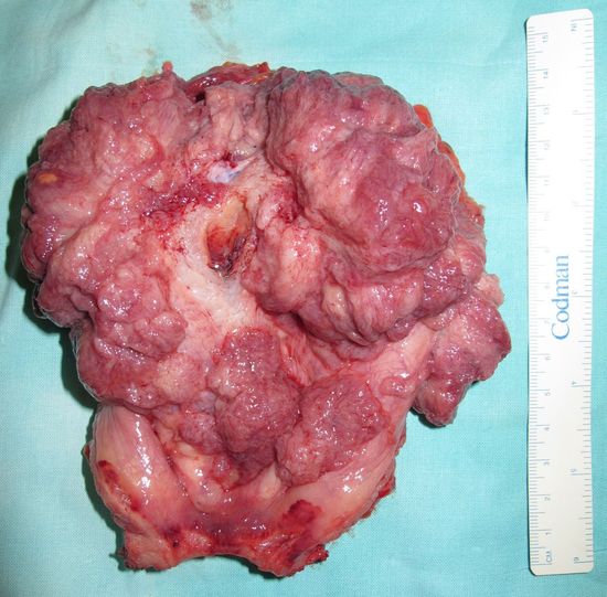 Удаленный мочевой пузырь с опухолью