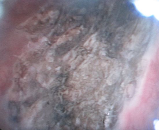 Ложе после удаление опухоли