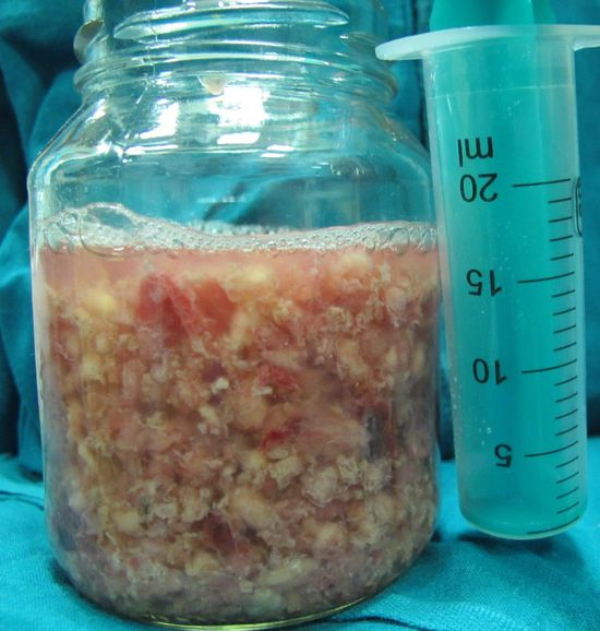 Удаленная опухолевая ткань