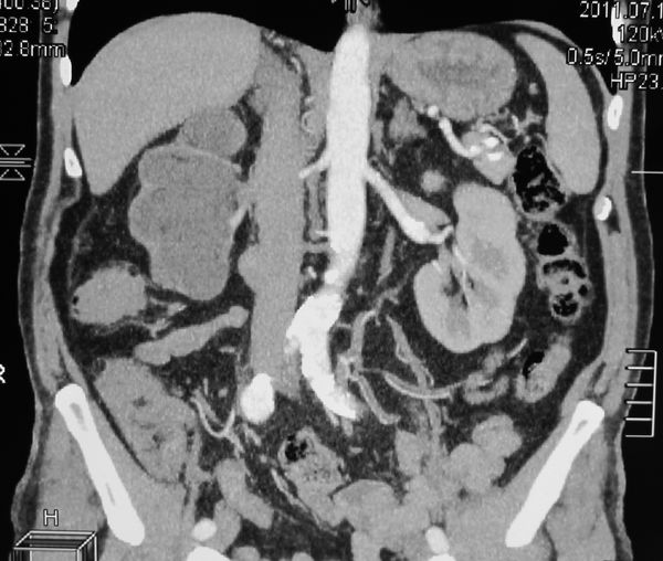 Гидронефротическая трансформация правой почки. Паренхима источнена. ее практически нет.