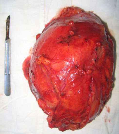 Удаленная почка