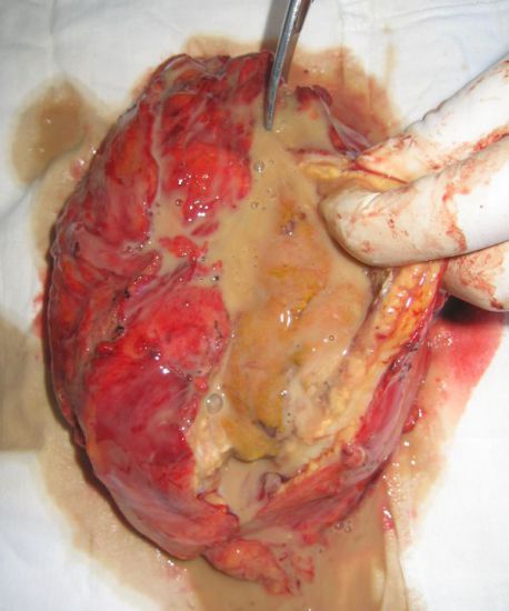 Абсцесс почки