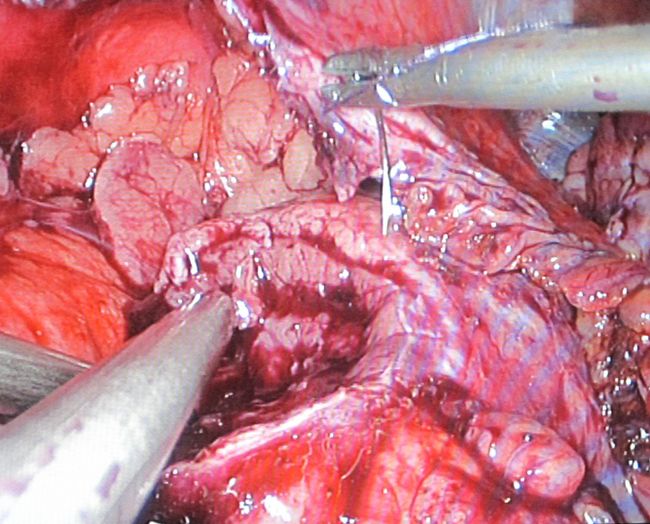 Ушивание ложа опухоли после резекции 