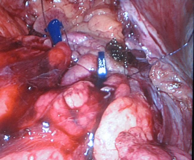 Ушитая паренхима почки