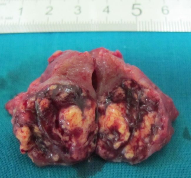 Удаленная опухоль