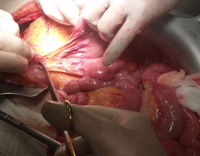 Мобилизация селезеночного изгиба ободочной кишки