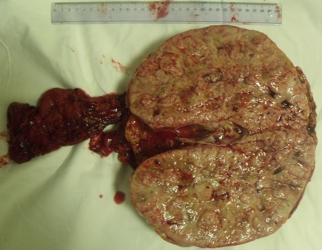 Удаленная почка, замещенная опухолью