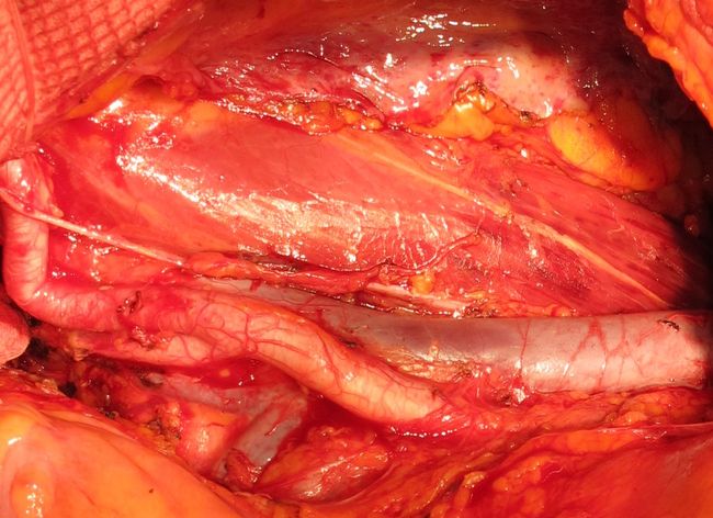 Ложе правой почки после ее удаления