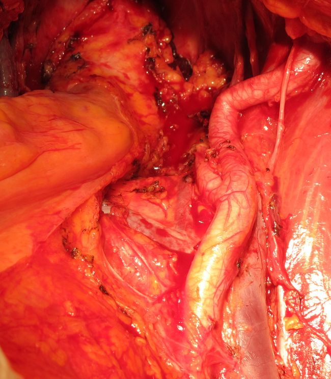 Ложе мочевого пузыря после цистпростатэктомии