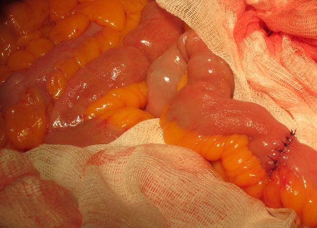 Однорядный кишечный шов после формирования илеокондуита