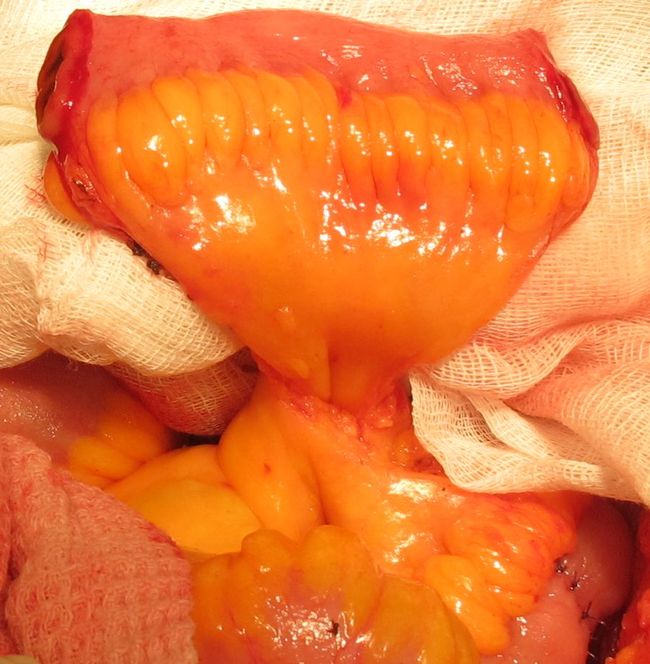 Сформироваанный илеокондуит