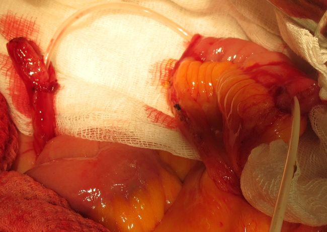 Мочеточниковый  интубатор заведен в почечную лоханку через мочеточник и проведен через илеокондуит