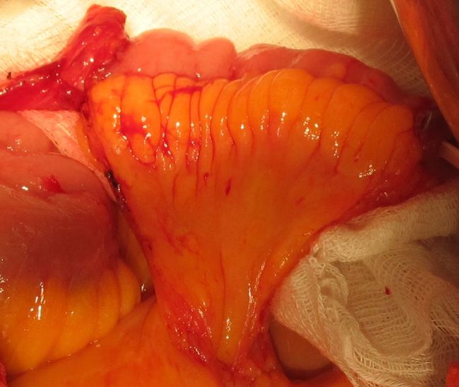 Сформирован анастмоз между левым мочеточником и мочевым резервуаром