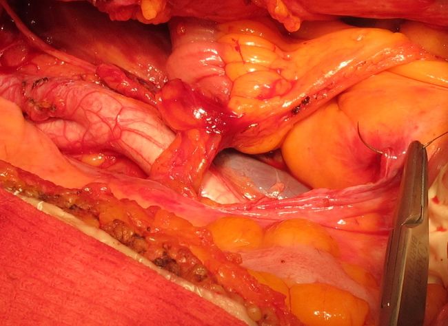 Перитонизация мочевого резервуара и 