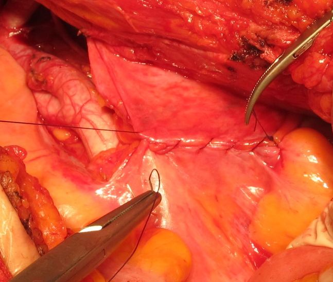 Перитонизация мочевого резервуара и зоны аорто-подвздошной лимодиссекции