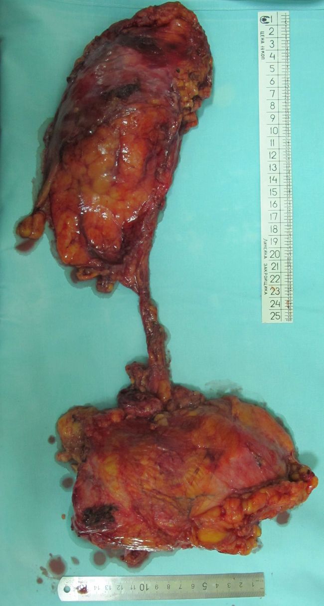 Удаленный препарат (мочевой пузырь с простатой, мочеточник и правая почка)