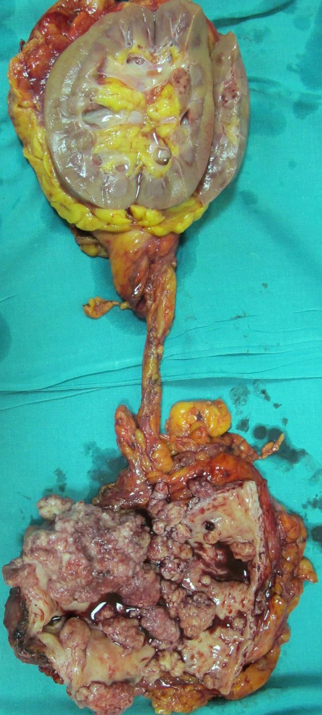 Удаленный препарат (мочевой пузырь с простатой, мочеточник и правая почка)