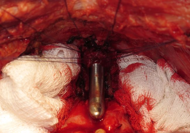 Буж заведен в уретру