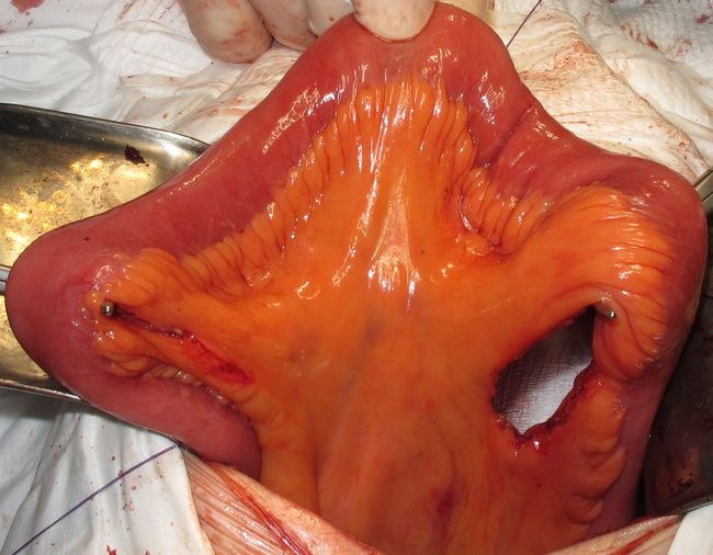 Выбор участка подвздошной кишки для формирования мочевого резервуара