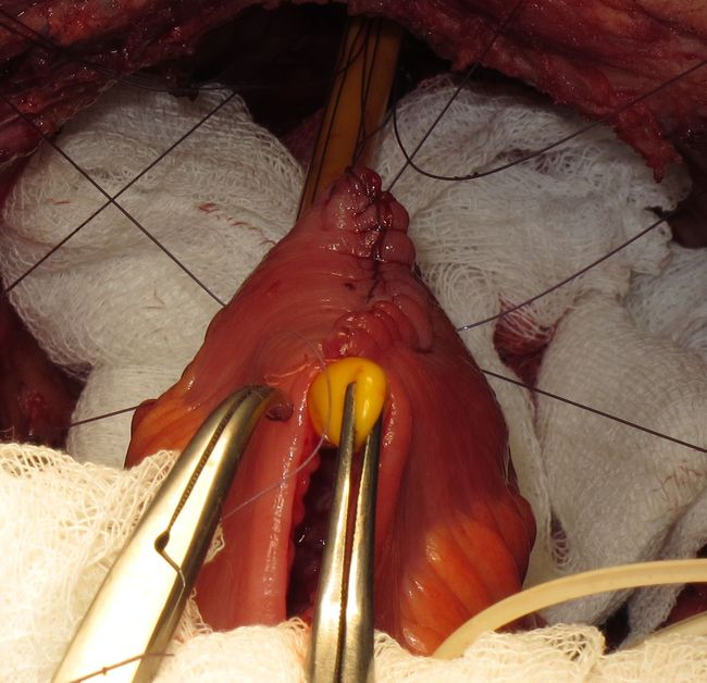 Анастомозирование мочевого резервуара с уретрой