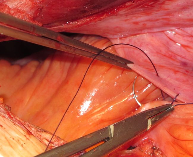 Перитонизация зоны мочеточнико-резервуарных анастмозоов