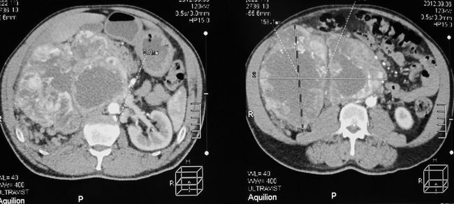 Опухоль правой почки (компьютерная томография)
