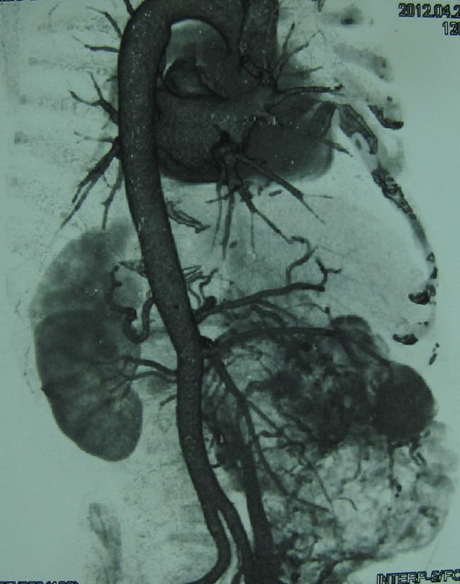 Опухоль правой почки (компьютерная томография с сосудистым контрастированием)