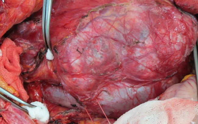 Мобилизация правой почки с опухолью