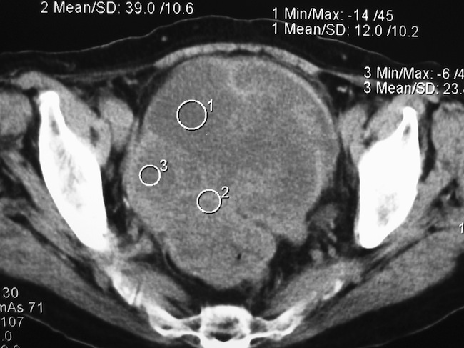Компьютераня томография малого таза