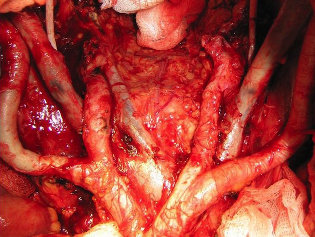 Малый таз после удаления местно-распространенной опухоли