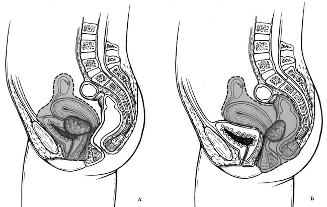 Передняя и задняя эвисцерации малого таза