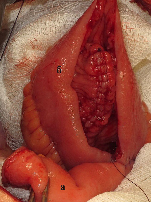 Подвздошно-кишечный мочевой J-резервуар