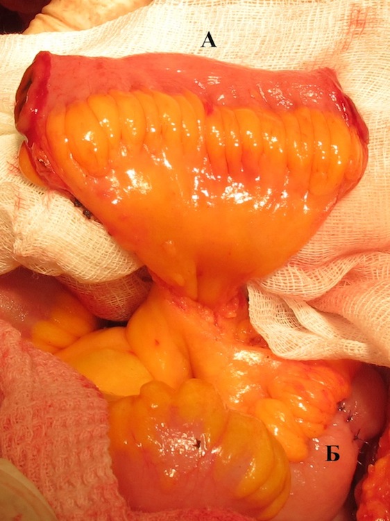 Сегмент подвздошной кишки