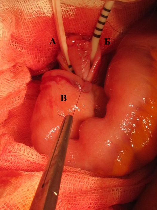 Формирование мочеточнико-кишечных анастомозов