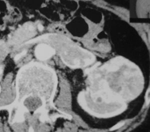 тромб в левой почечной и нижней полой вене