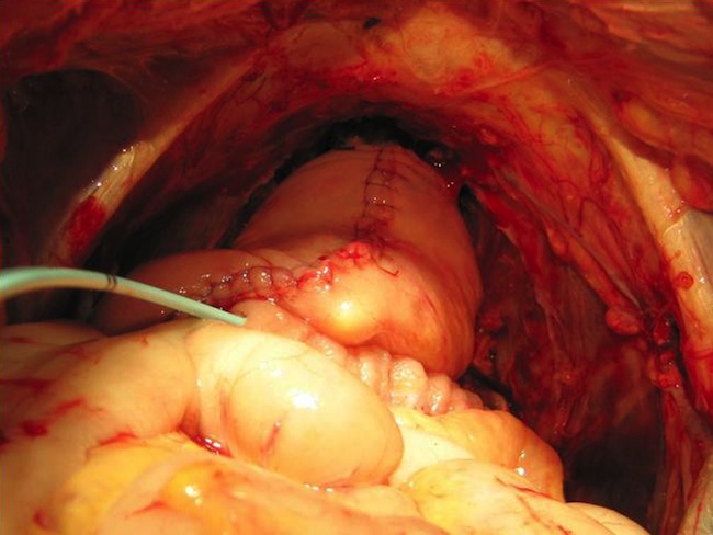 Вновь сформированный мочевой резервуар (необладдер)