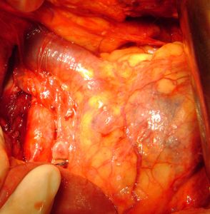 тромб в левой почечной вене