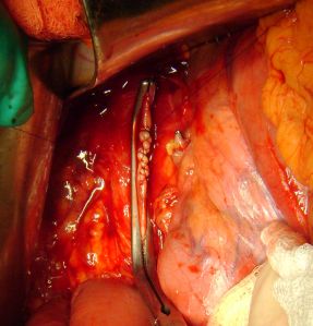 ушивание нижней полой вены