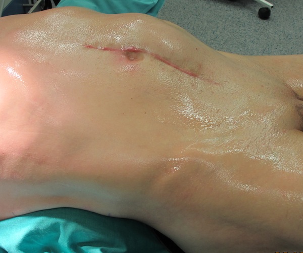 Пациент на операционном столе. Асимметрия живота за счет рецидива опухоли.