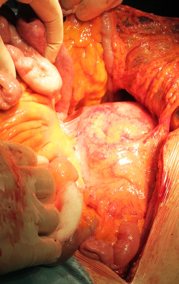 Рецидивная опухоль инфильтрирует брыжейку нисходящего отдела ободочной кишки.