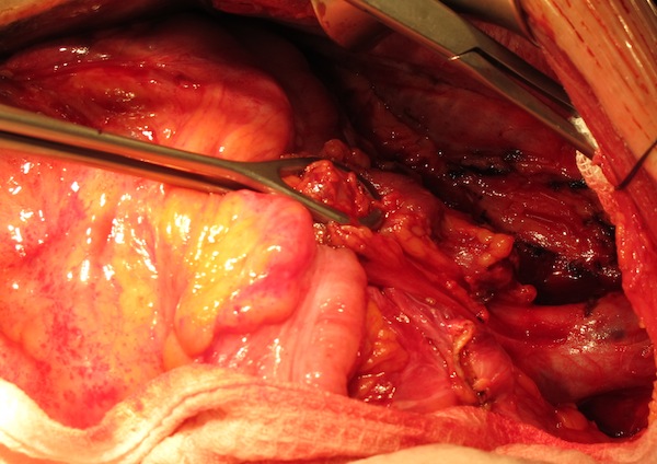 Мобилизация опухоли.