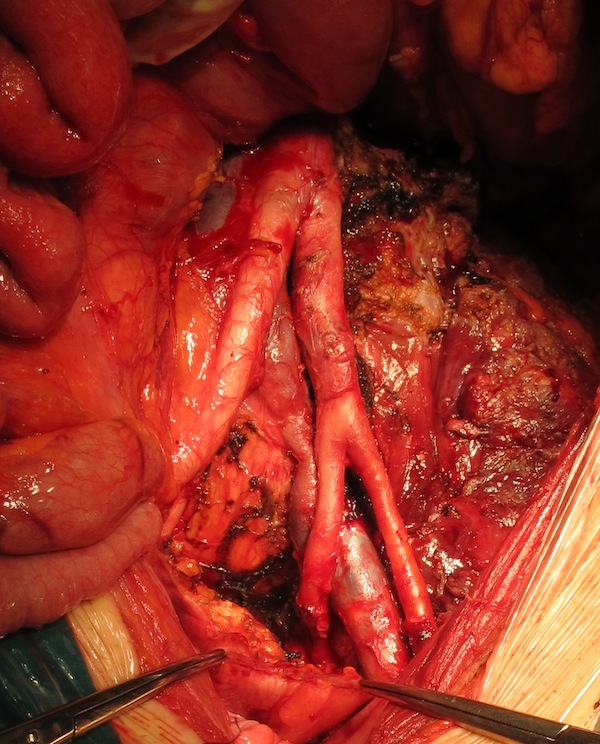 Вид операционной раны после удаления опухоли. Скелетированные аорта и подвздошные сосуды.