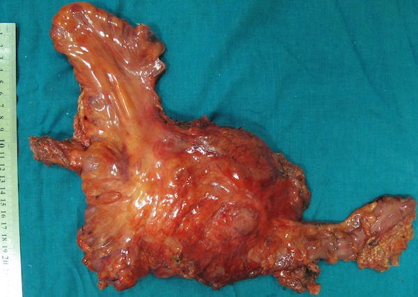Удаленный препарат. Мочеточник с рецидивной опухолью и левой половиной ободочной кишки.