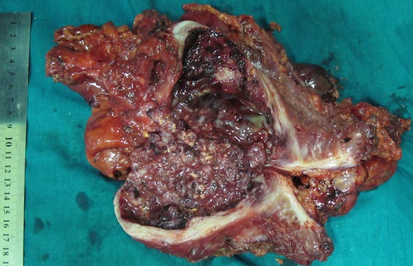 Удаленный препарат. Рассеченный мочеточник с рецидивной опухолью и левой половиной ободочной кишки.